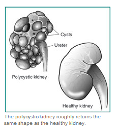 polycystic kidney disease